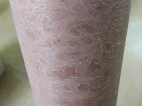 鱼鳞病可以不治疗吗